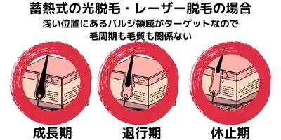 最新の蓄熱式光脱毛・レーザー脱毛は「毛周期・毛質ともに関係ない」