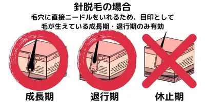 針脱毛は「成長期」と「退行期」で効果あり