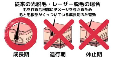 従来の光脱毛・レーザー脱毛は「成長期」のみ効果あり