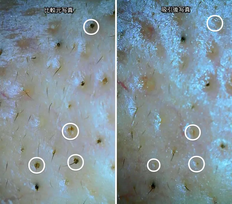 毛穴の黒ずみを吸引器で吸引した際のマイクロスコープで撮ったビフォーアフター写真