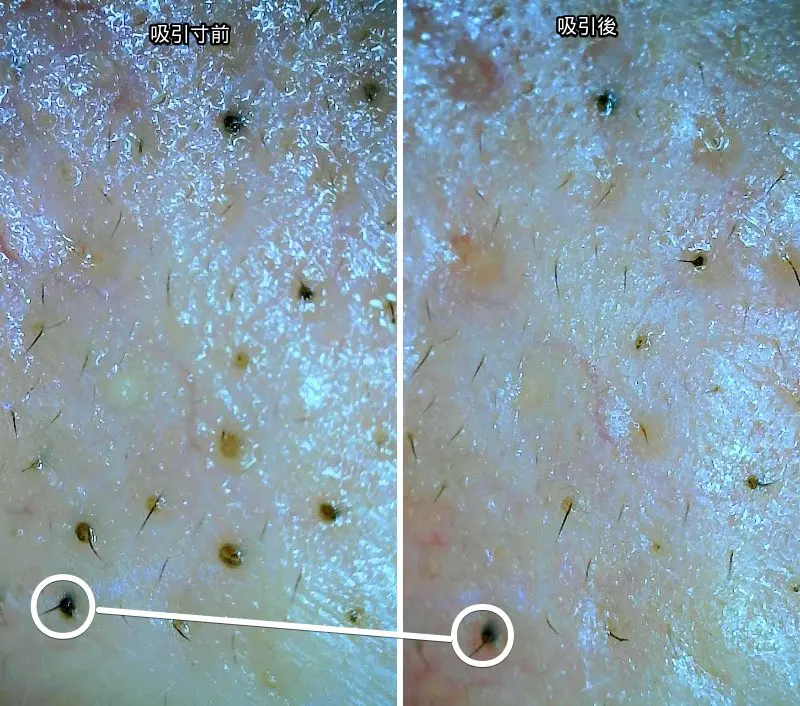 毛穴の黒ずみを吸引器で吸引した際のマイクロスコープで撮ったビフォーアフター写真