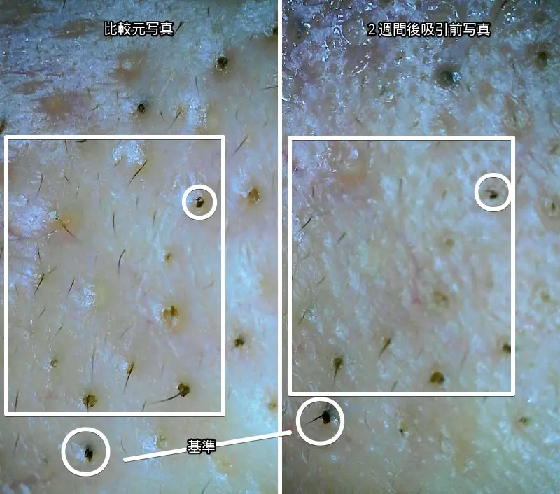 毛穴の黒ずみを吸引器で吸引した際のマイクロスコープで撮ったビフォーアフター写真
