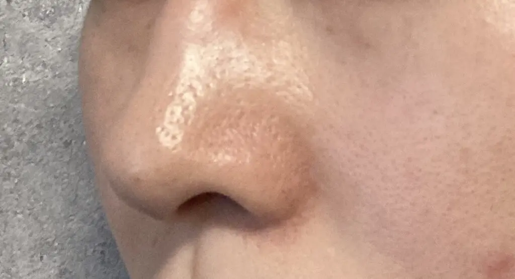 30代後半の鼻と頬の毛穴の黒ずみ・開きの写真