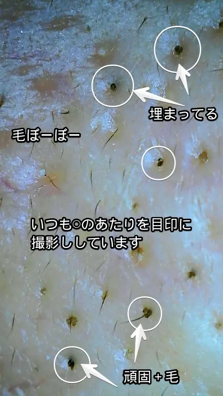 毛穴の黒ずみをマイクロスコープで撮った写真