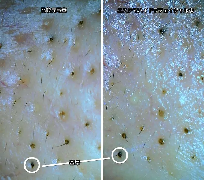 毛穴の黒ずみをハイドラフェイシャルした際のマイクロスコープで撮ったビフォーアフター写真