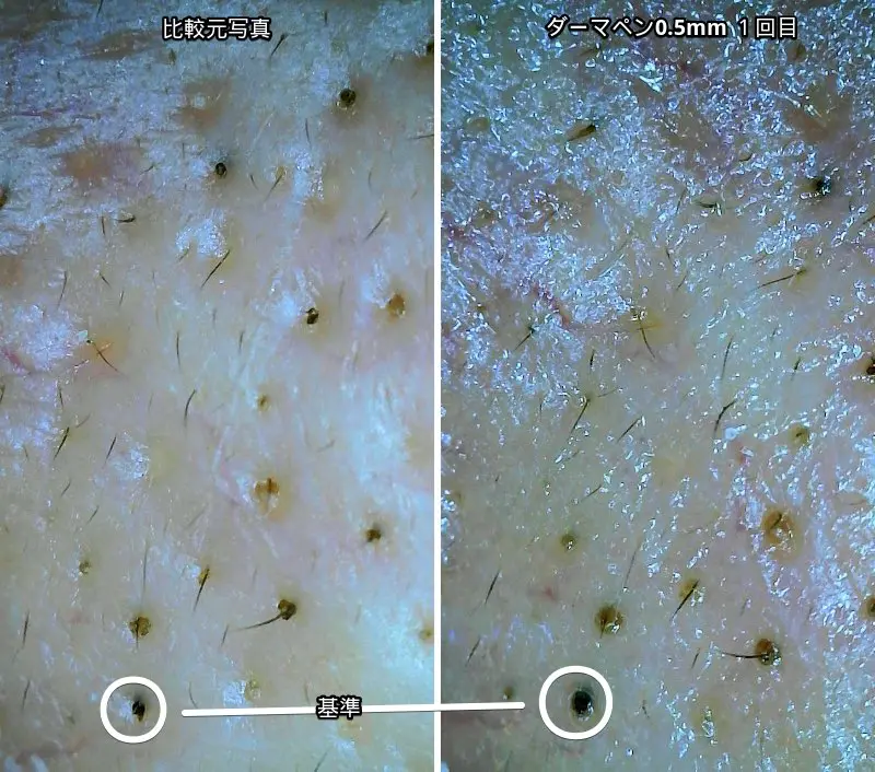 毛穴の黒ずみダーマペンで施術した際のマイクロスコープで撮ったビフォーアフター写真