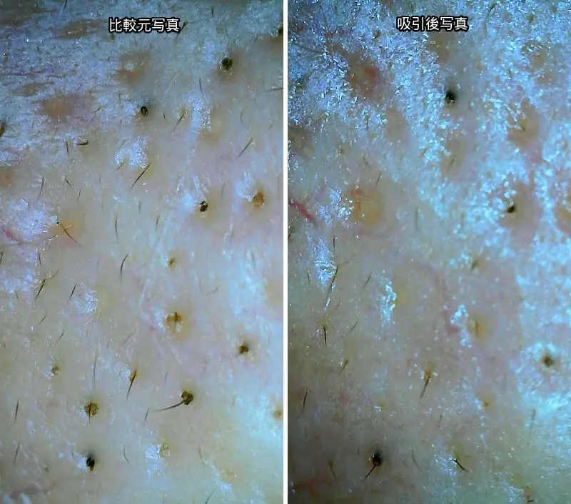毛穴の黒ずみを吸引器で吸引した際のマイクロスコープで撮ったビフォーアフター写真