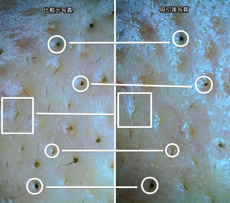 毛穴の黒ずみを吸引器で吸引した際のマイクロスコープで撮ったビフォーアフター写真