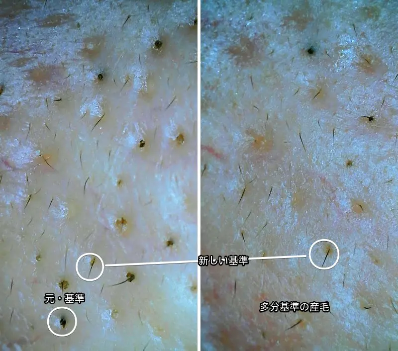 毛穴の黒ずみを吸引器で吸引した際のマイクロスコープで撮ったビフォーアフター写真